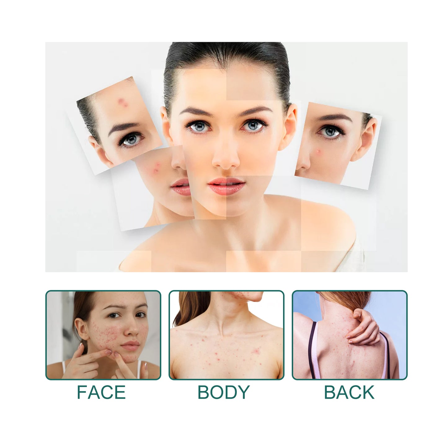 Eelhoe Star Acne Patch – Salicylic Acid & Tea Tree Oil Acne Treatment