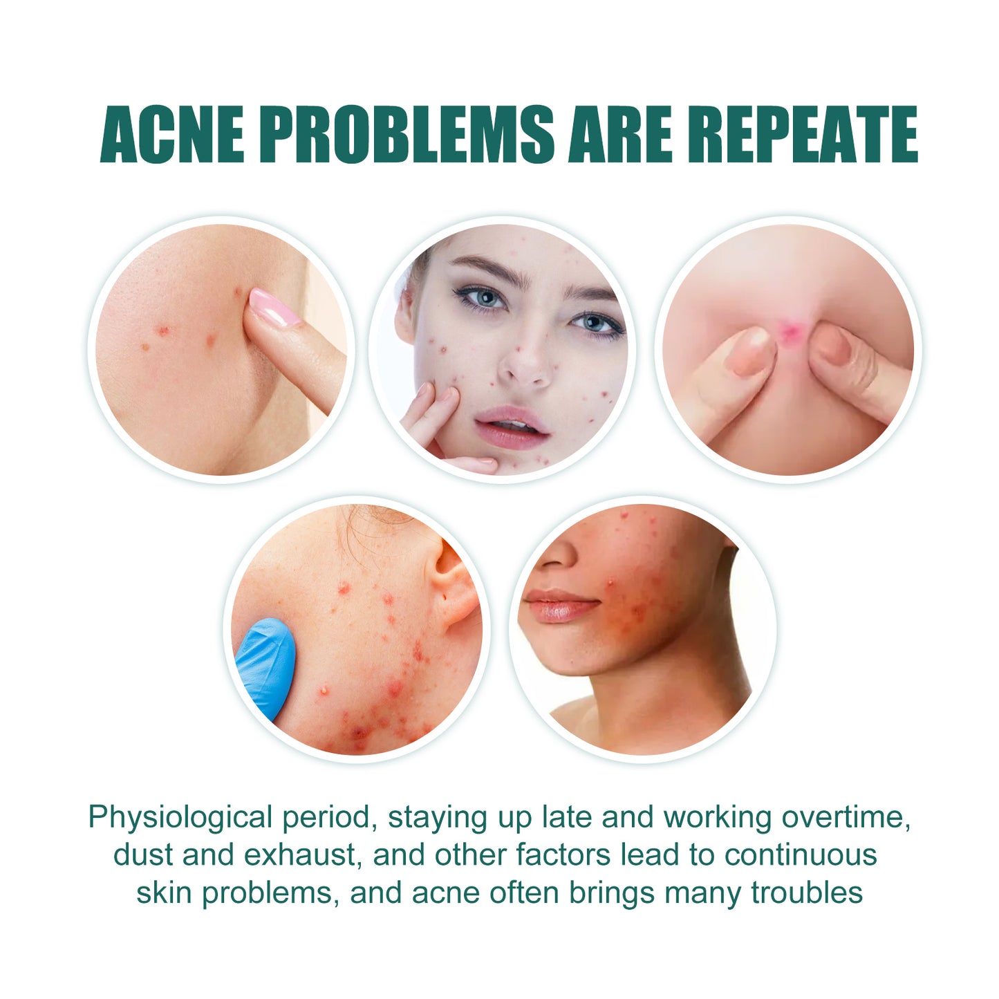 Eelhoe Star Acne Patch – Salicylic Acid & Tea Tree Oil Acne Treatment