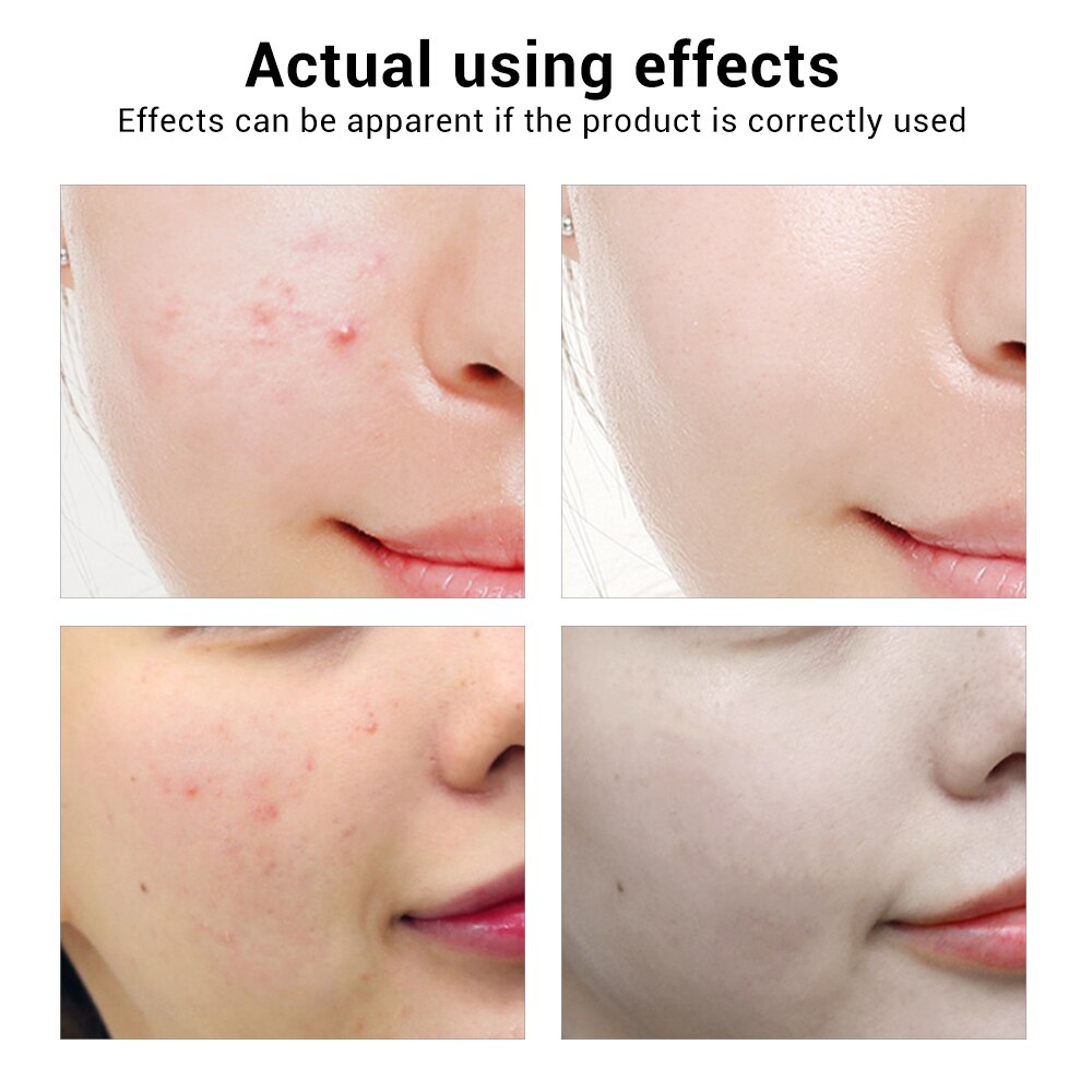 BREYLEE Acne Treatment Serum Mask – Anti-Acne & Pimple Scar Remover