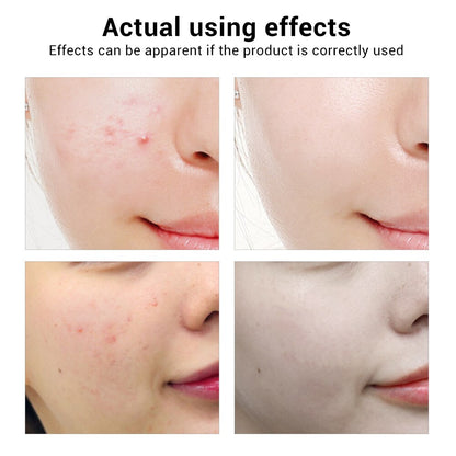 BREYLEE Acne Treatment Serum Mask – Anti-Acne & Pimple Scar Remover